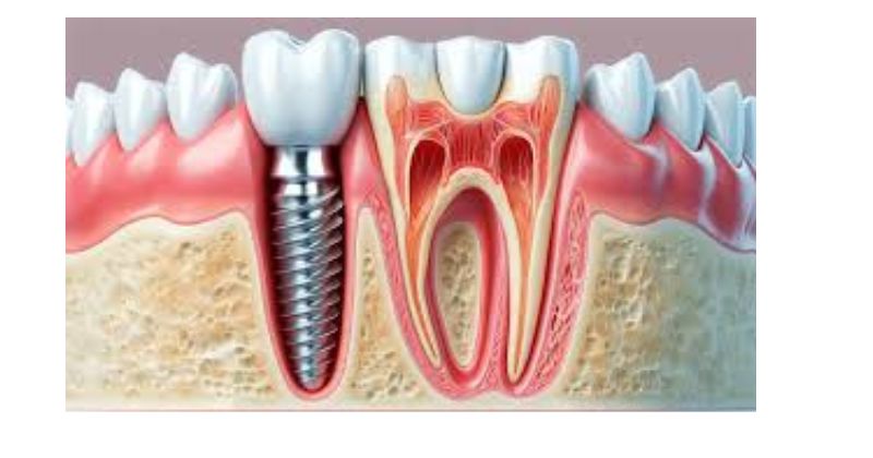 Evolution of Dental Implants: A Modern Solution to Missing Teeth
