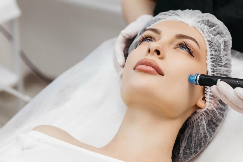 RF Microneedling