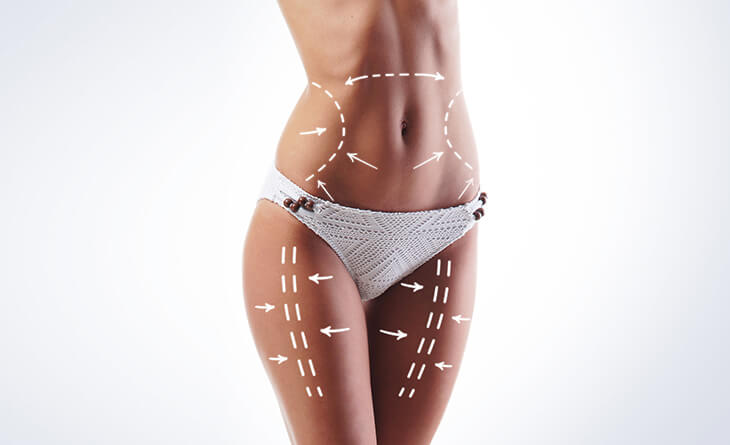 liposuction surgery in delhi - dr priya bansal