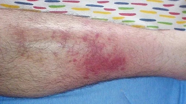 Azithromycin A Powerful Antibiotic Solution Cellulitis