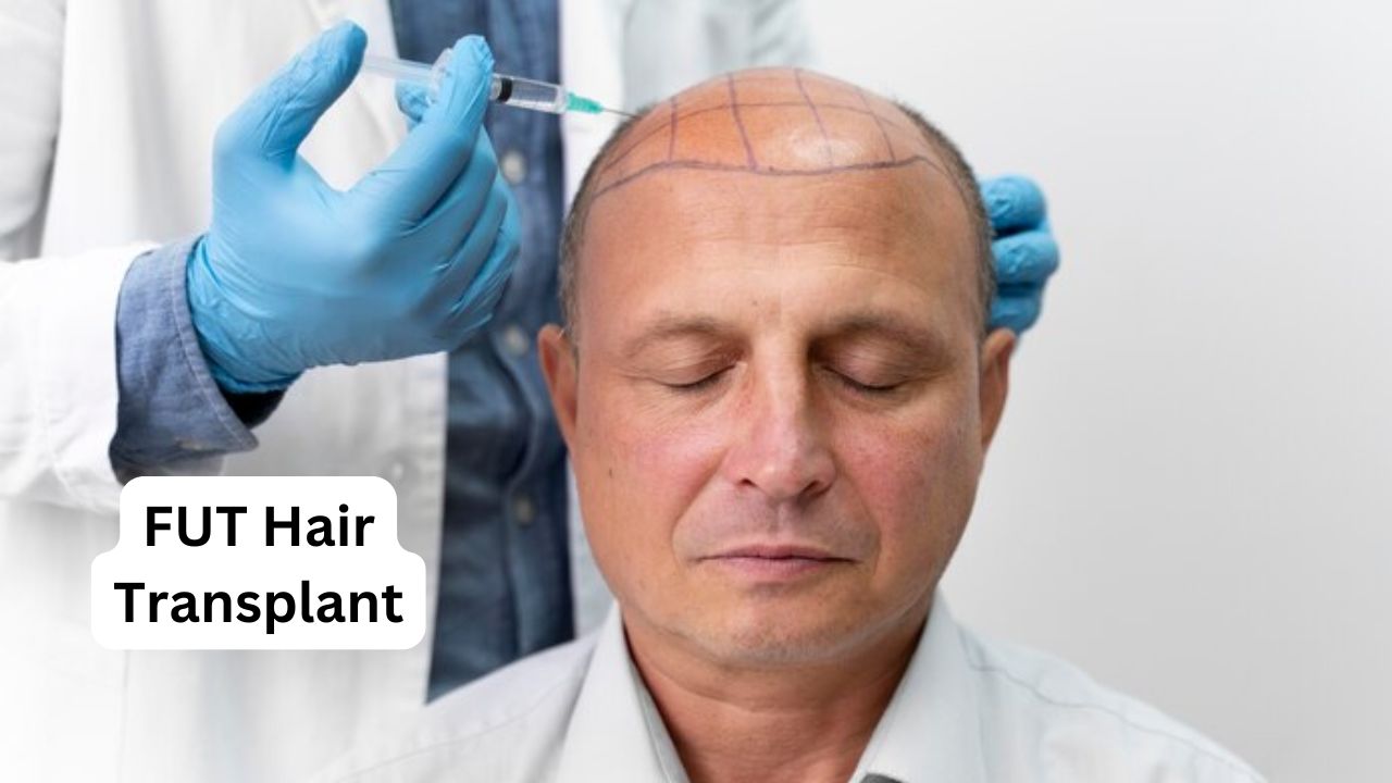 FUT Hair Transplant